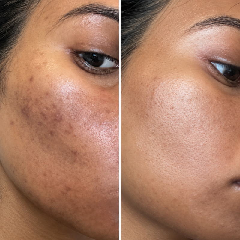 Hyperpigmentation